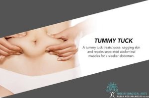 A woman's stomach with the words tummy tuck.