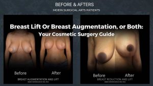 Breast Lift Or Breast Augmentation, or Both