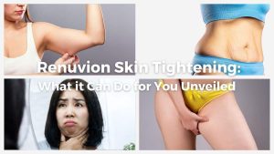 Renuvion Skin Tightening What it Can Do for You