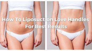 How To Liposuction Love Handles For Best Results