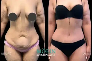 Abdominoplasty Before and After Los Angeles CA 