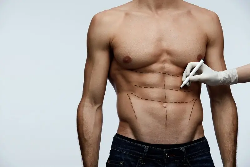 Before, During, and After HD Lipo in LA