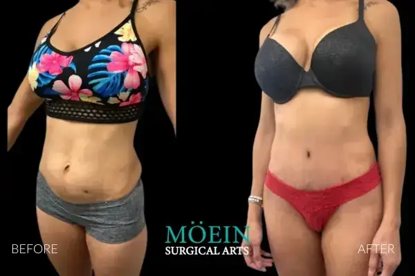 Mommy Makeover Before and After Beverly Hills