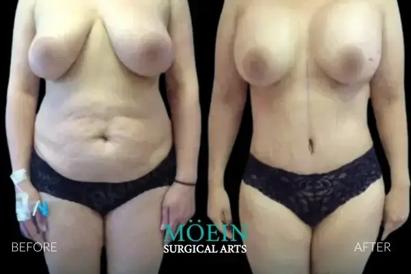 Mommy Makeover Results Beverly Hills
