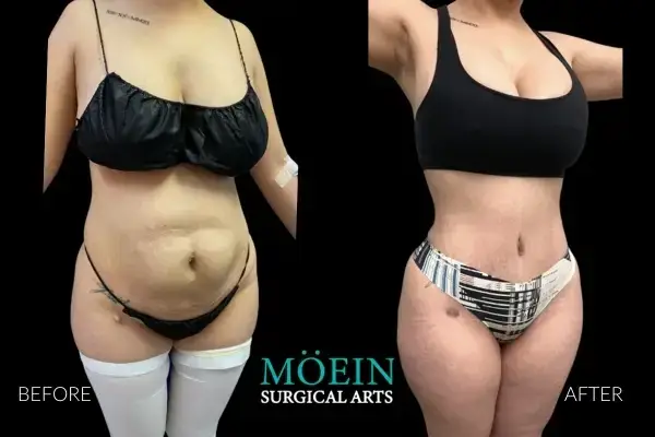 Mommy Makeover Results Beverly Surgical Arts