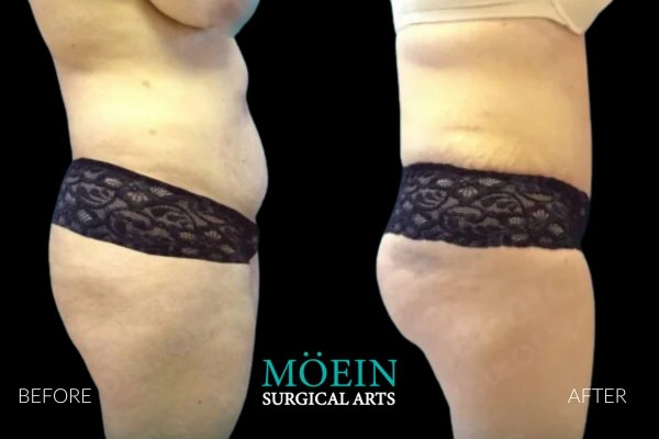 Mommy Makeover Results Bin LA, CA