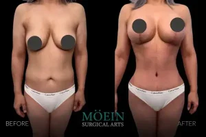 Mommy Makeover Results in Beverly Hills