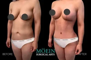 Mommy Makeover Results in Beverly Surgical Arts