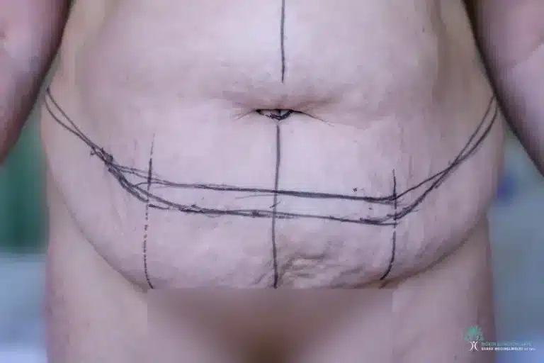 Panniculectomy