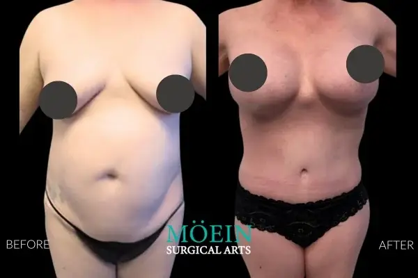 Tummy Tuck Before and After LA CA