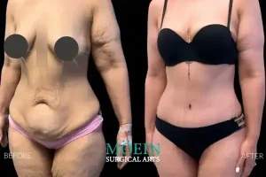 Tummy Tuck Before and After LA CA 