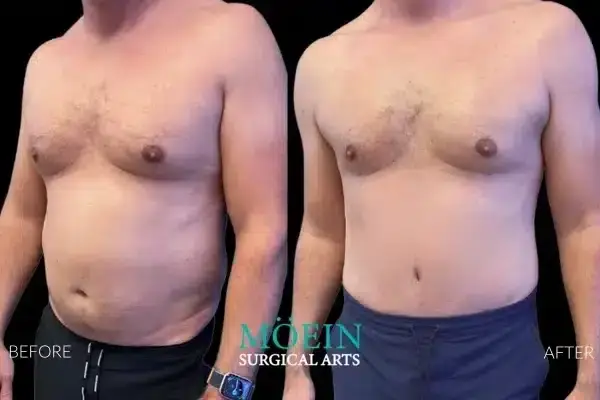 Tummy Tuck Before and After Los Angeles