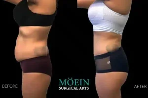 Tummy Tuck Before and After Los Angeles