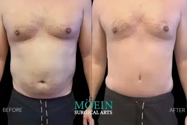 Tummy Tuck Before and After Los Angeles CA