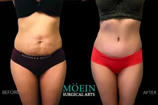 Tummy Tuck Before and After Los Angeles CA