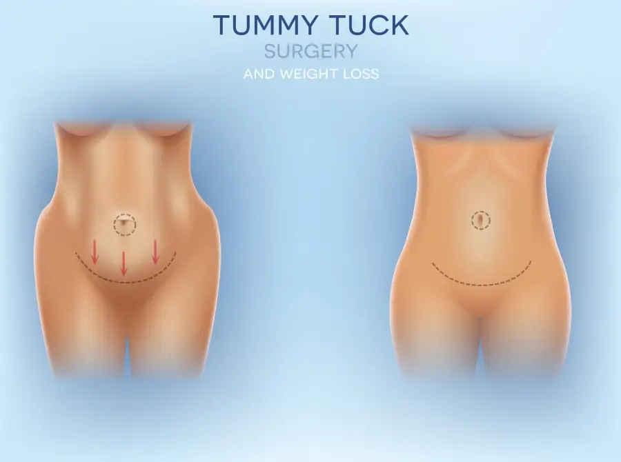 Tummy Tuck Beverly Hills and LA