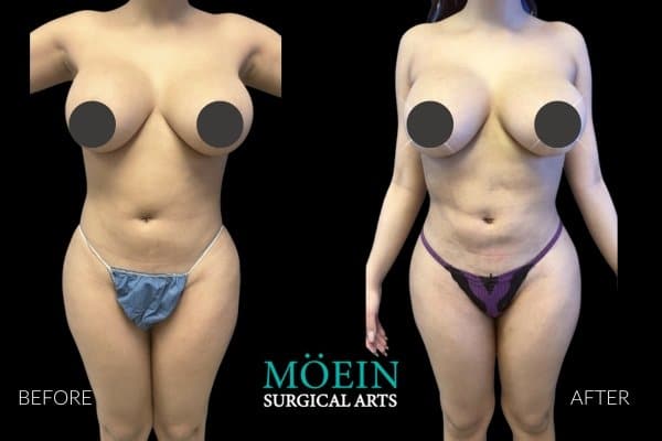 Vaser Liposuction Before and After Los Angeles CA