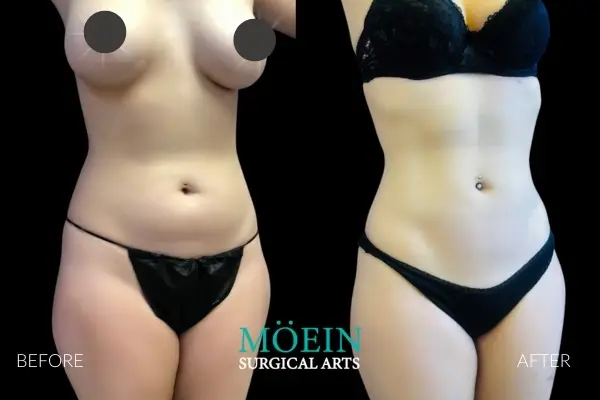Vaser Liposuction HD Liposuction Before and After LA