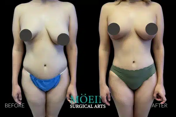 Vaser Liposuction HD Liposuction Before and After LA