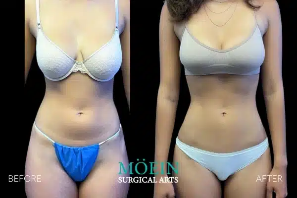 Vaser Liposuction HD Liposuction Before and After LA CA