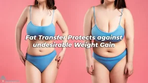 Fat Transfer Protects against undesirable Weight Gain- LA, CA