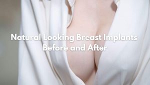 Natural Looking Breast Implants Before and After