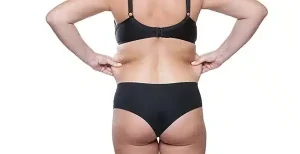 velashape or liposuction in Los Angeles.